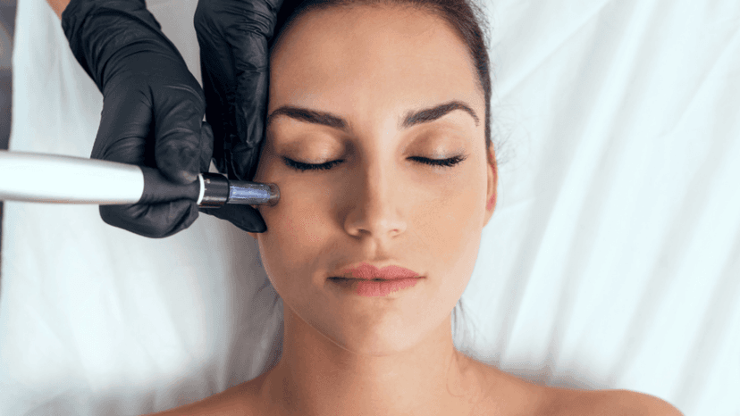 Beneficios del Dermapen